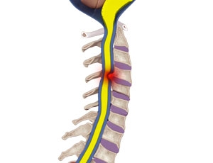 Cervical Myopathy: Recognizing Symptoms and Seeking Treatment