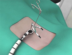 Endoscopic & Minimally Invasive Spine Surgery: A Better Way to Heal