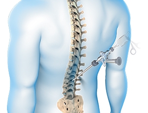 Endoscopic Spine Surgery: Innovative Solutions for Back Pain Relief