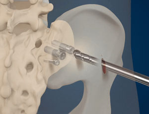 Understanding Sacroiliac Fusion: What You Need to Know