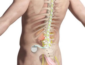 Understanding Spinal Cord Stimulation: A Lifeline for Chronic Pain