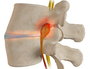 Understanding Spinal Stenosis: Symptoms, Diagnosis, and Treatment