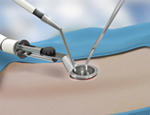 When Should You Consider Spine Surgery?