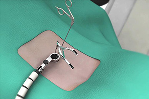Endoscopic & Minimally Invasive Spine Surgery: A Better Way to Heal