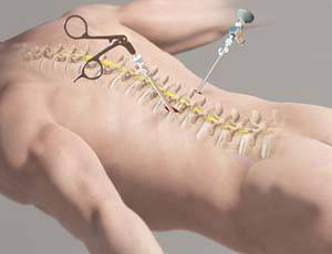 Minimally Invasive Spine Surgery: Benefits and Recovery